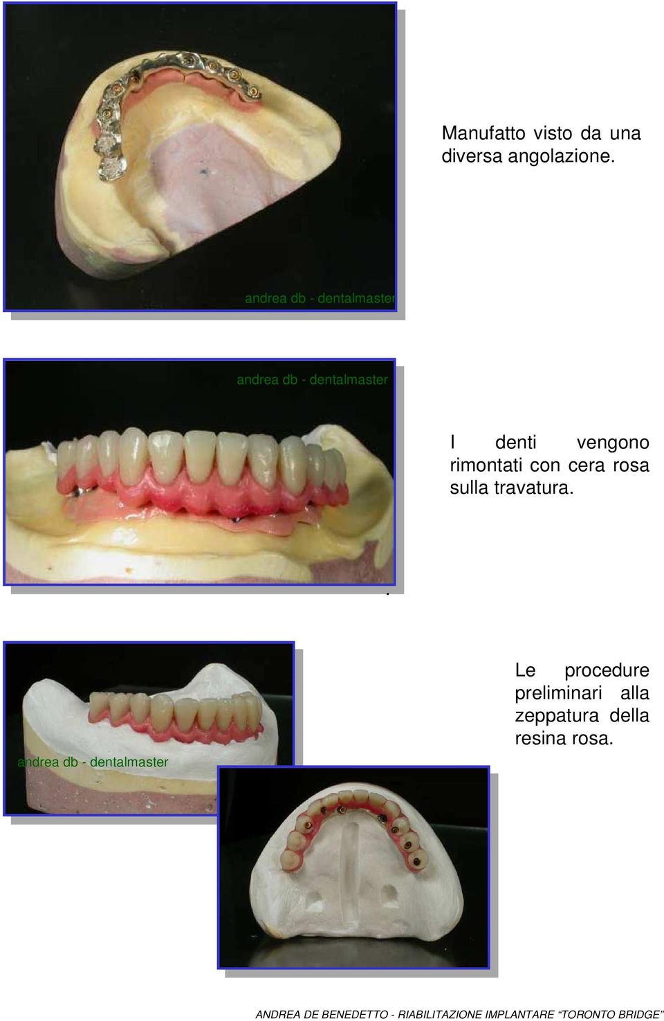 I denti vengono rimontati con cera rosa