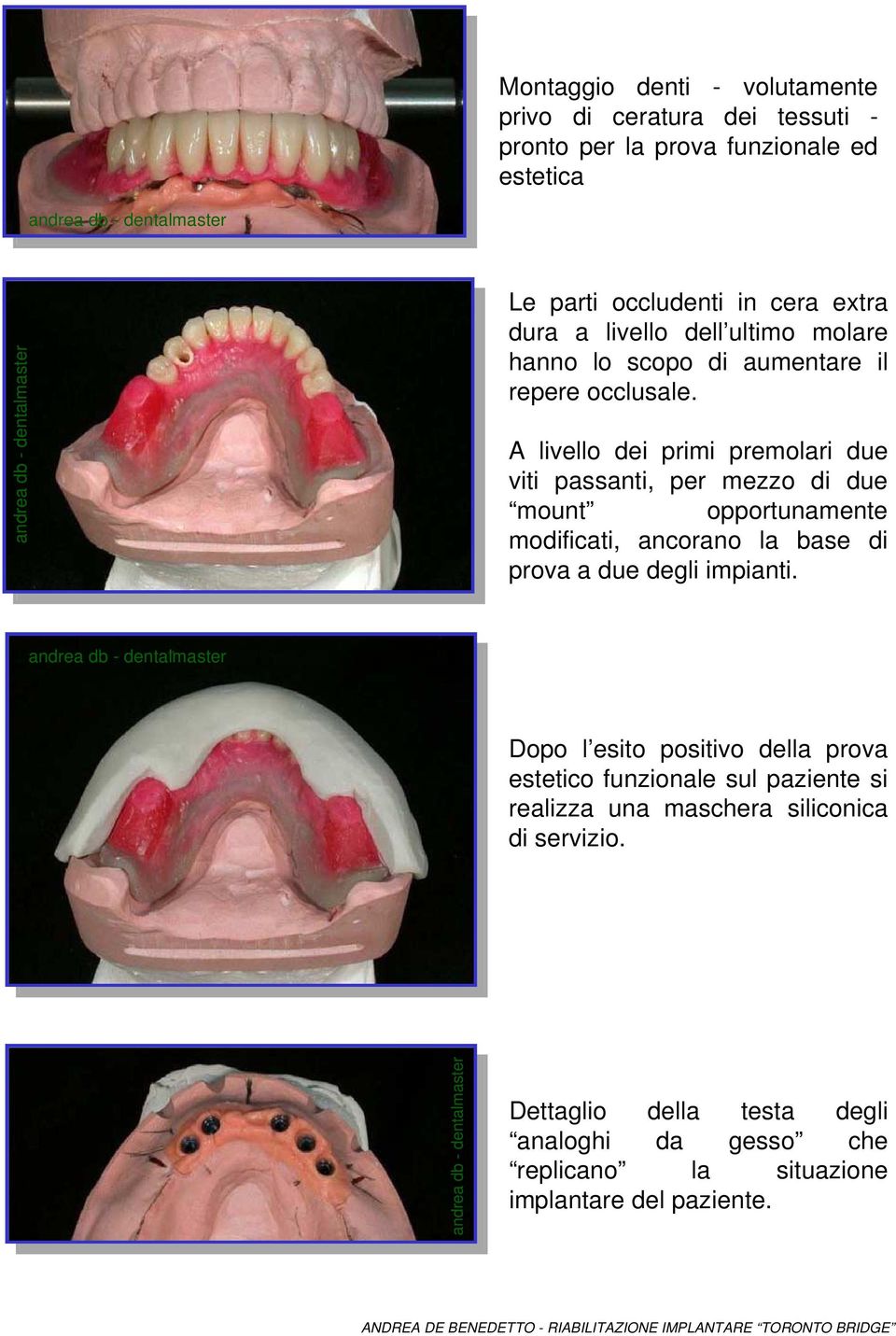 A livello dei primi premolari due viti passanti, per mezzo di due mount opportunamente modificati, ancorano la base di prova a due degli impianti.