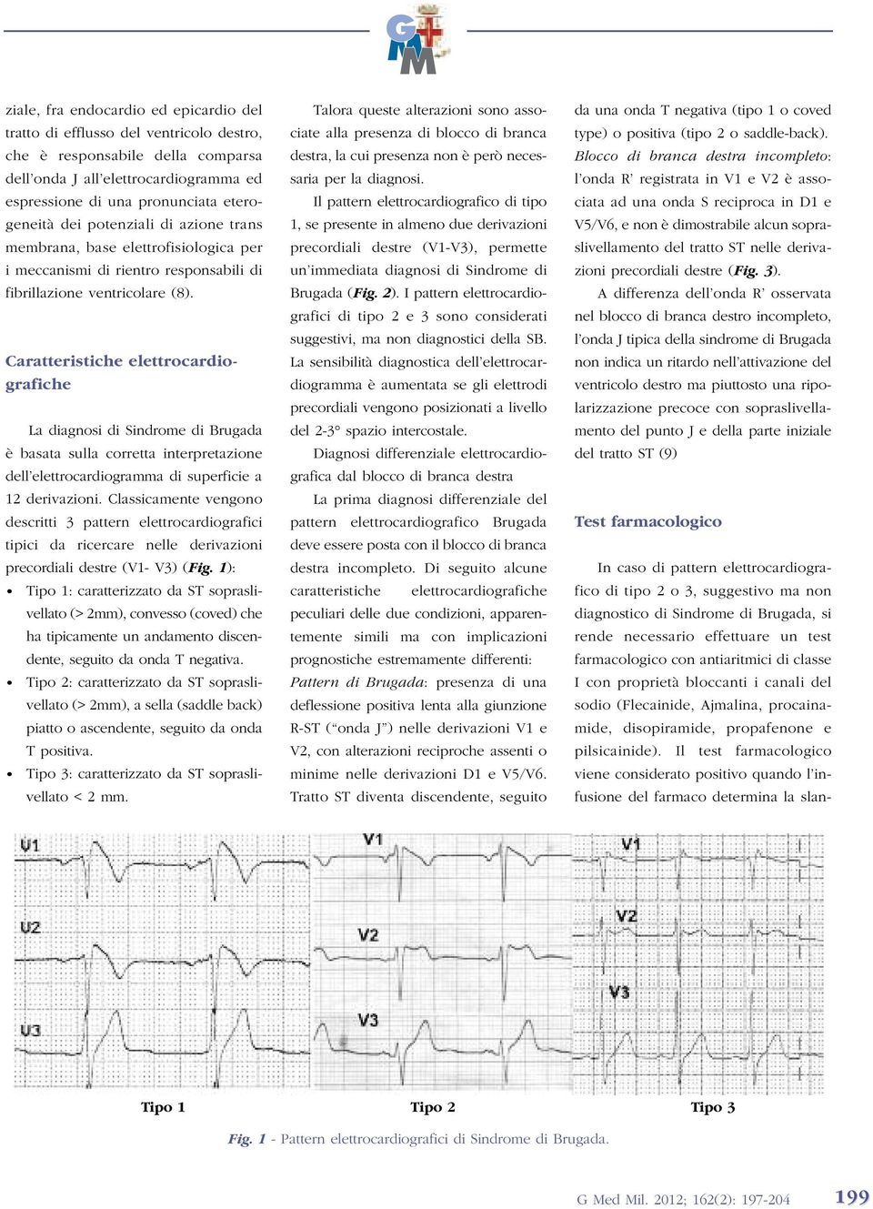 Caratteristiche elettrocardiografiche La diagnosi di Sindrome di Brugada è basata sulla corretta interpretazione dell elettrocardiogramma di superficie a 12 derivazioni.