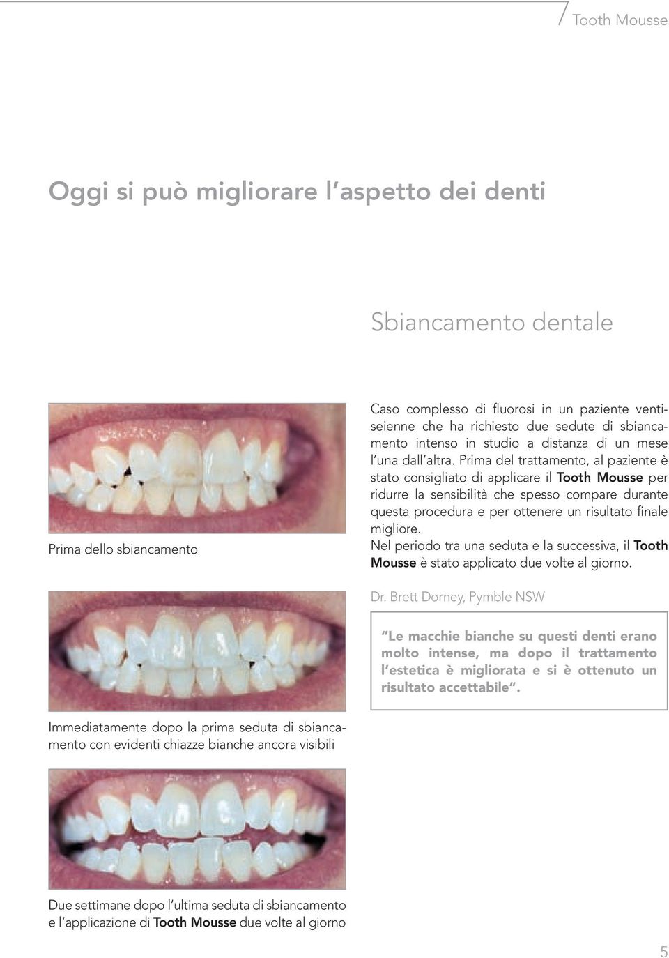 Prima del trattamento, al paziente è stato consigliato di applicare il Tooth Mousse per ridurre la sensibilità che spesso compare durante questa procedura e per ottenere un risultato finale migliore.