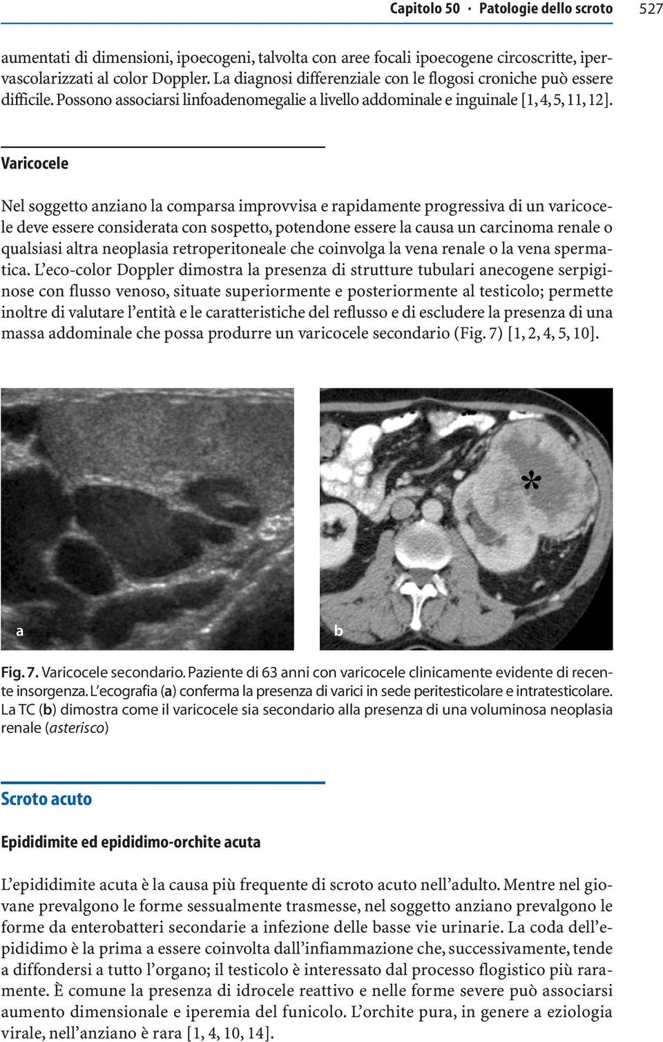 Varicocele Nel soggetto anziano la comparsa improvvisa e rapidamente progressiva di un varicocele deve essere considerata con sospetto, potendone essere la causa un carcinoma renale o qualsiasi altra