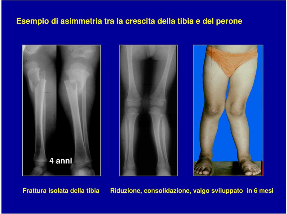 Frattura isolata della tibia