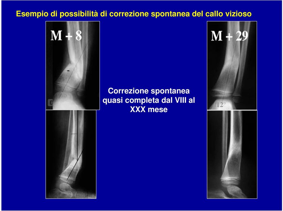 vizioso 25 Correzione spontanea