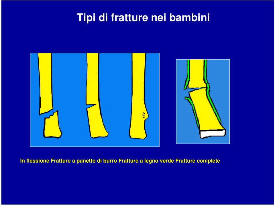 Fratture a panetto di burro