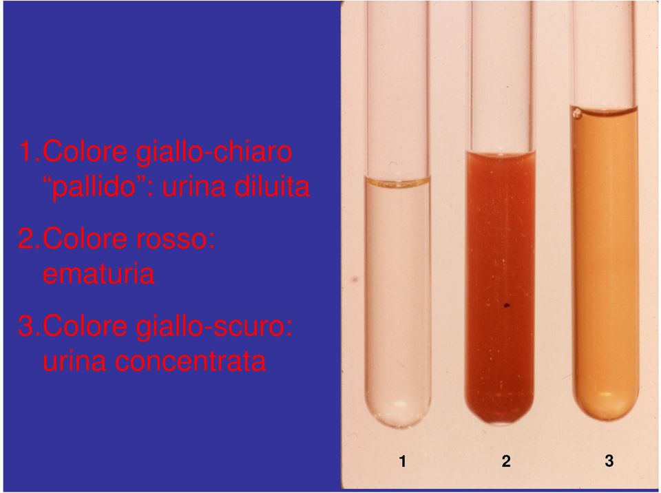 Colore rosso: ematuria 3.