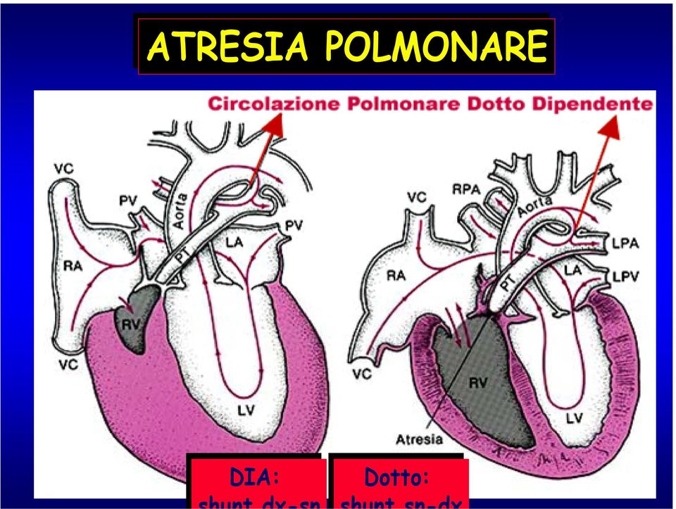 sn-dx ATRESIA