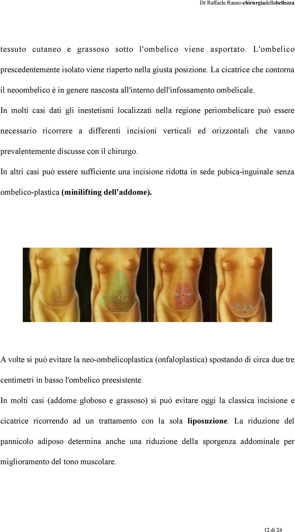 In molti casi dati gli inestetismi localizzati nella regione periombelicare può essere necessario ricorrere a differenti incisioni verticali ed orizzontali che vanno prevalentemente discusse con il