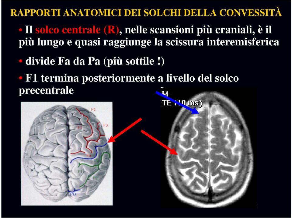 quasi raggiunge la scissura interemisferica divide Fa da Pa