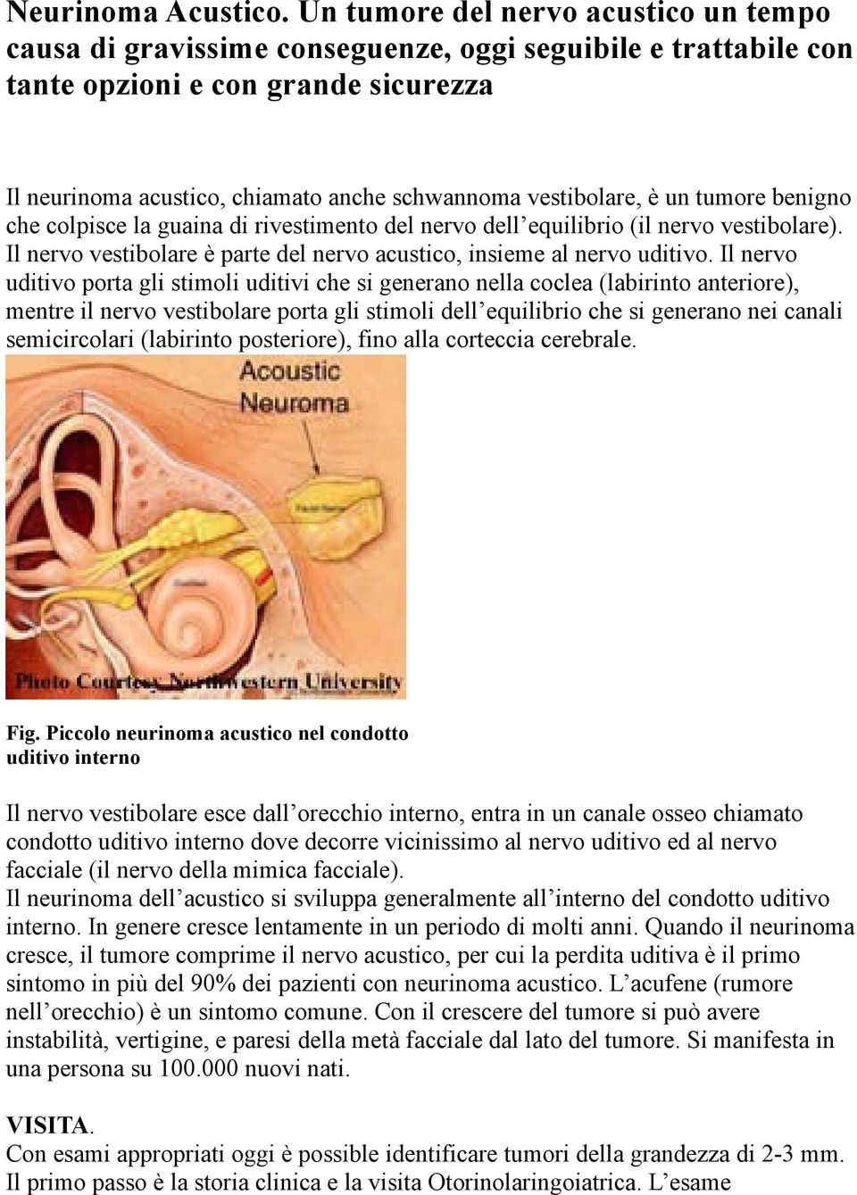 vestibolare, è un tumore benigno che colpisce la guaina di rivestimento del nervo dell equilibrio (il nervo vestibolare). Il nervo vestibolare è parte del nervo acustico, insieme al nervo uditivo.