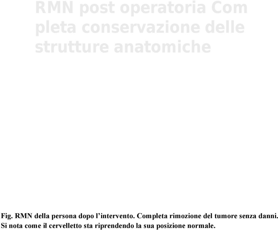 RMN della persona dopo l intervento.