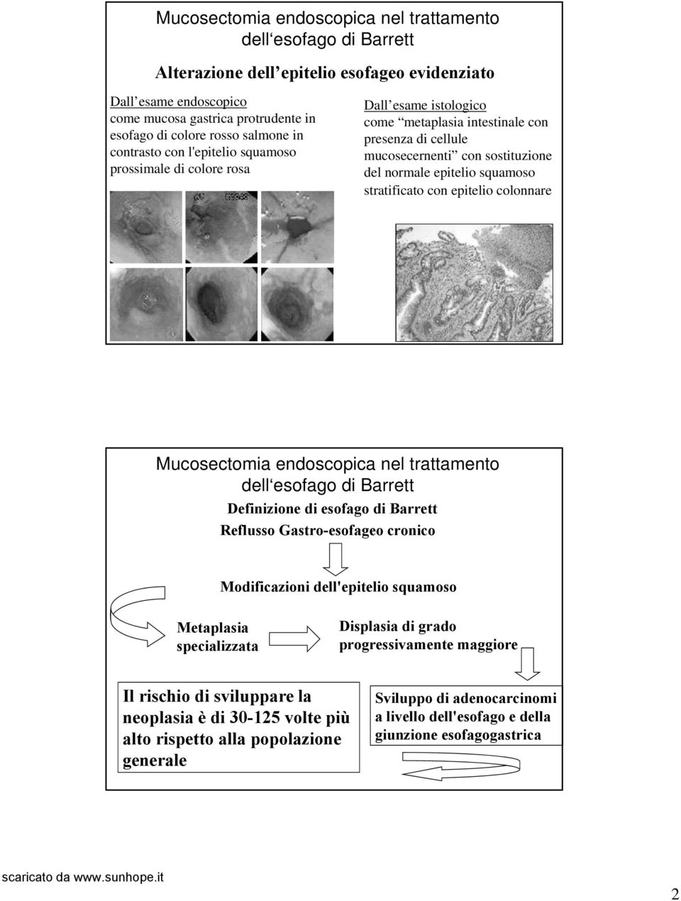 epitelio colonnare Definizione di esofago di Barrett Reflusso Gastro-esofageo cronico Modificazioni dell'epitelio squamoso Metaplasia specializzata Displasia di grado progressivamente