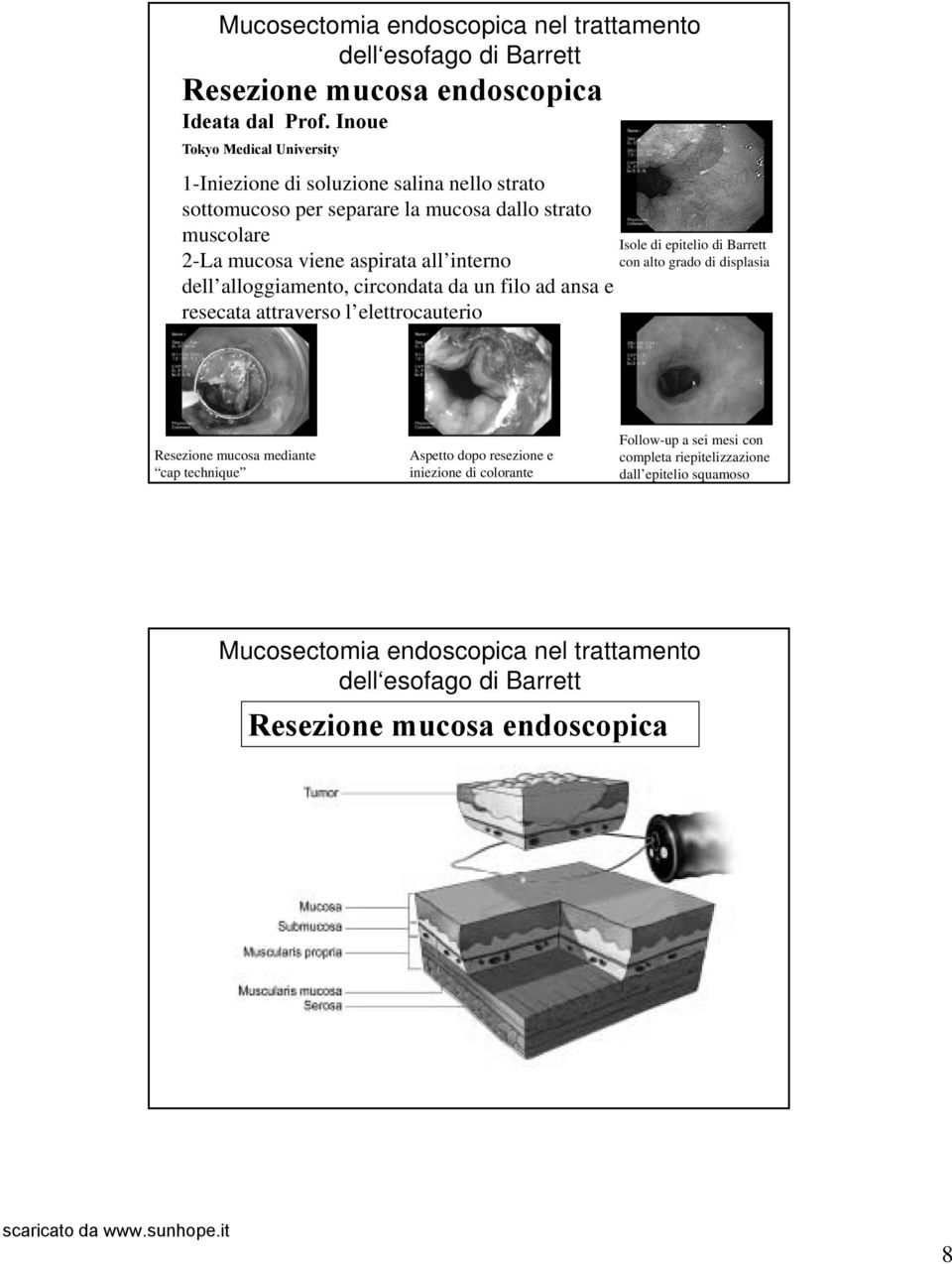 di epitelio di Barrett 2-La mucosa viene aspirata all interno con alto grado di displasia dell alloggiamento, circondata da un filo ad ansa