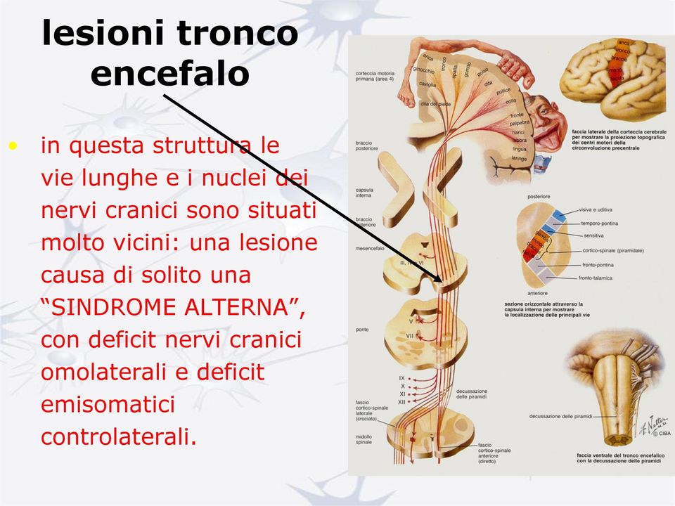 lesione causa di solito una SINDROME ALTERNA, con deficit