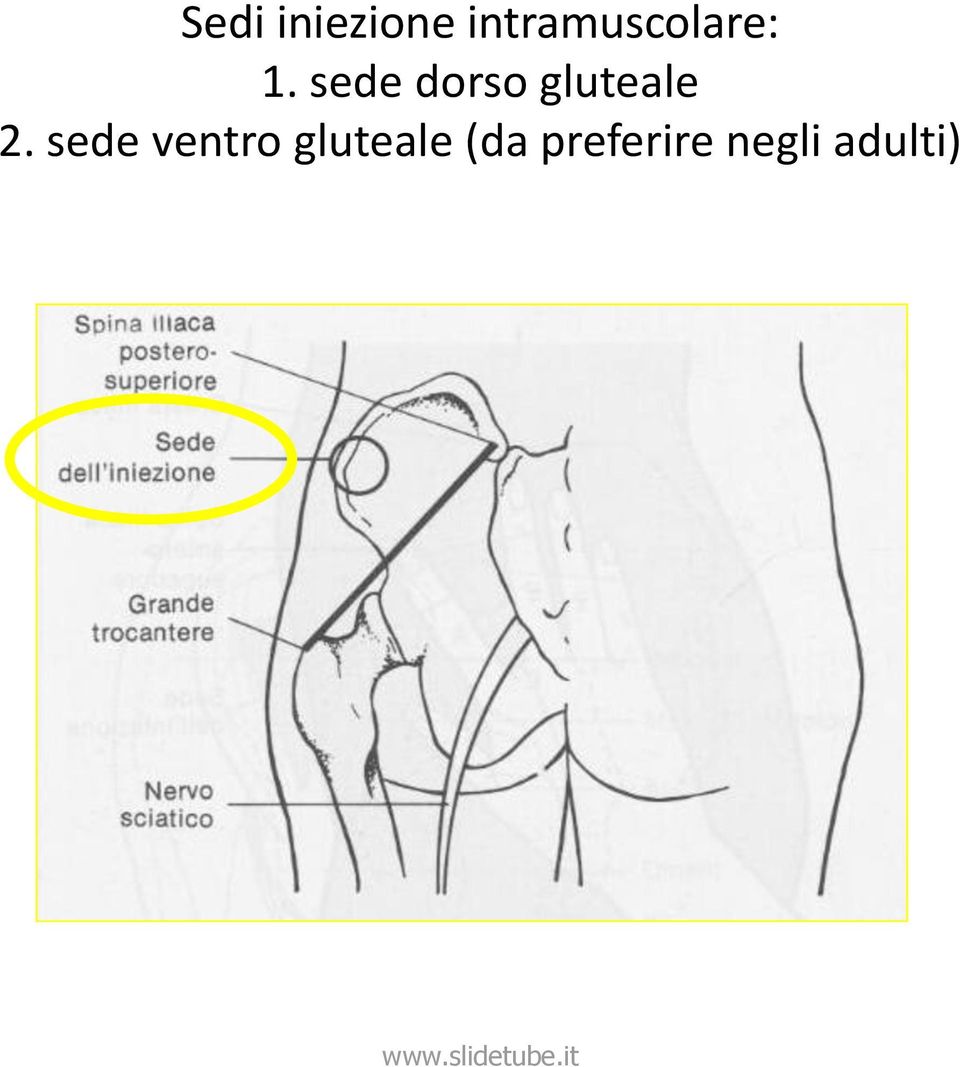 sede dorso gluteale 2.