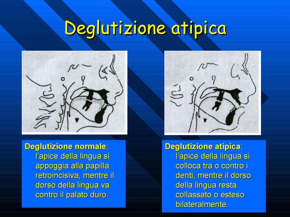 duro. Deglutizione atipica: l apice della lingua si colloca tra o contro i