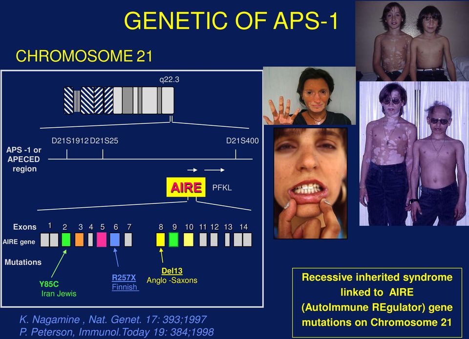 13 14 AIRE gene Mutations Y85C Iran Jewis R257X Finnish Del13 Anglo -Saxons K. Nagamine, Nat.