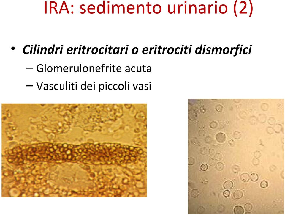 eritrociti dismorfici