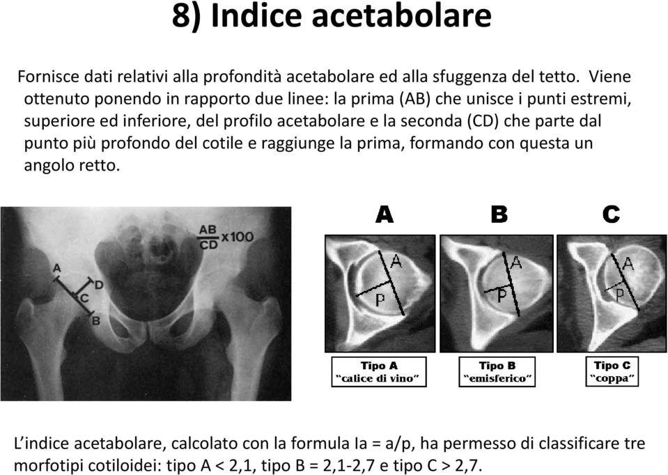 acetabolare e la seconda (CD) che parte dal punto più profondo del cotile e raggiunge la prima, formando con questa un angolo