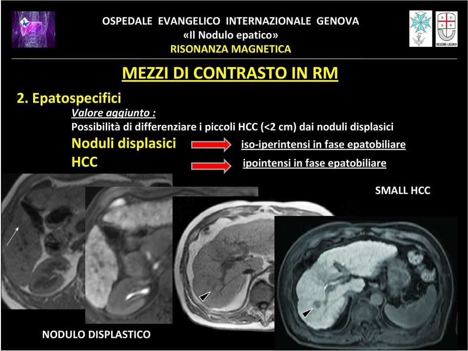 piccoli HCC (<2 cm) dai noduli displasici Noduli displasici HCC