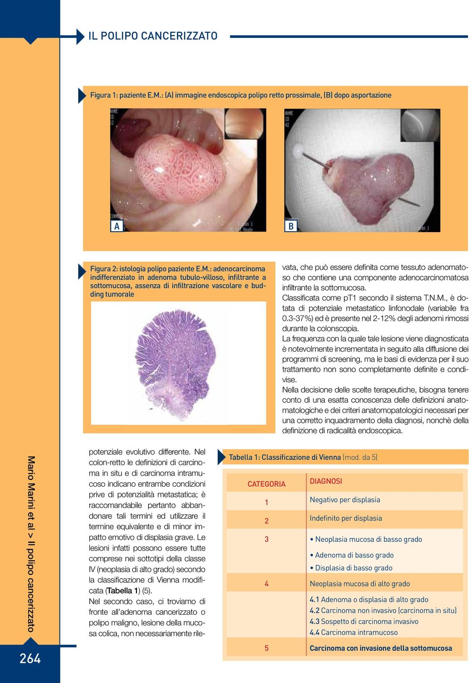 : adenocarcinoma indifferenziato in adenoma tubulo-villoso, infiltrante a sottomucosa, assenza di infiltrazione vascolare e budding tumorale vata, che può essere definita come tessuto adenomatoso che