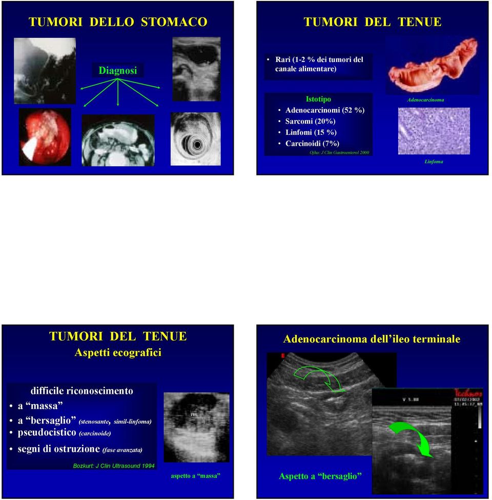 ecografici Adenocarcinoma dell ileo terminale difficile riconoscimento a massa a bersaglio (stenosante, simil-linfoma)