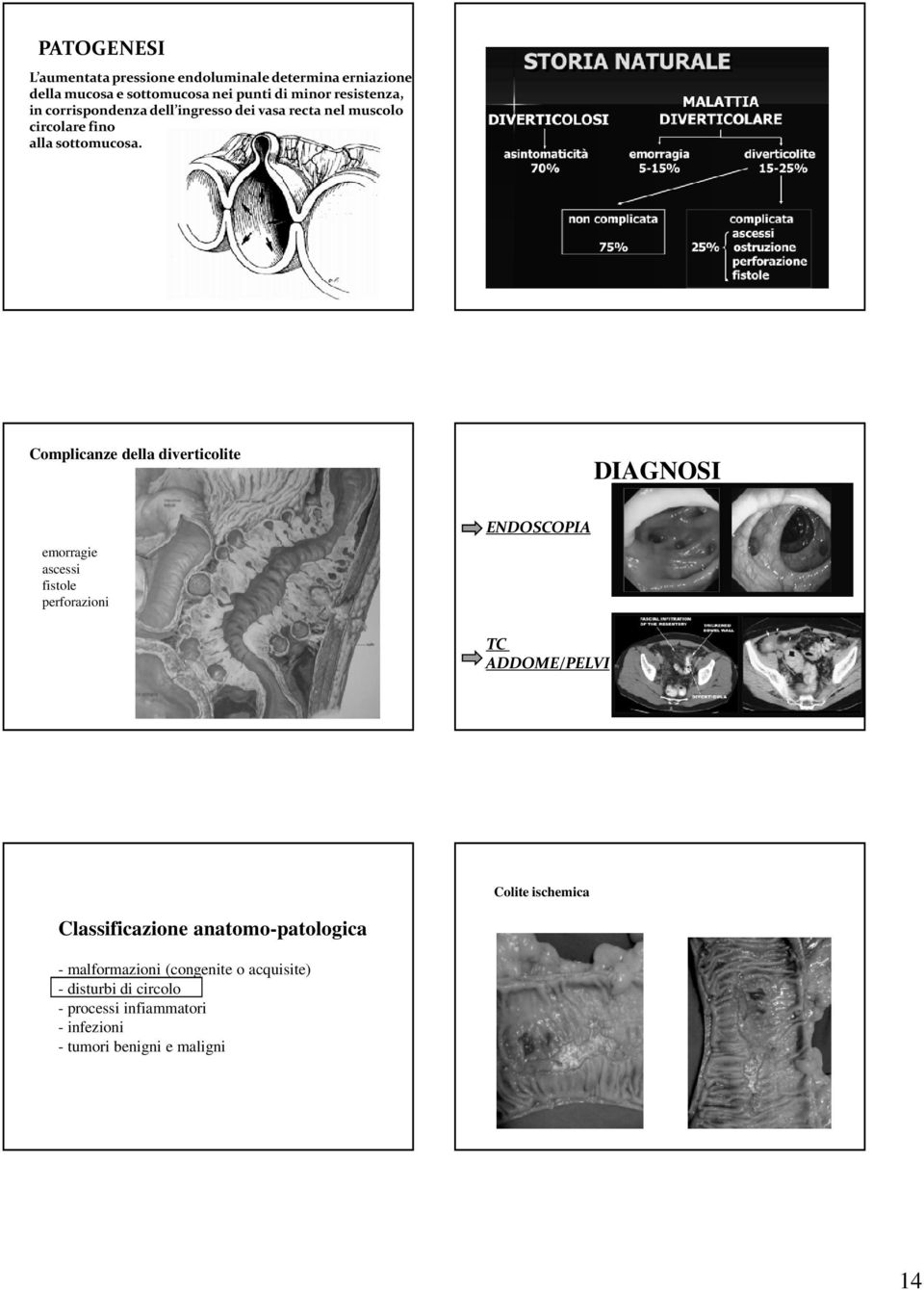 Complicanze della diverticolite DIAGNOSI emorragie ascessi fistole perforazioni ENDOSCOPIA TC ADDOME/PELVI Colite ischemica