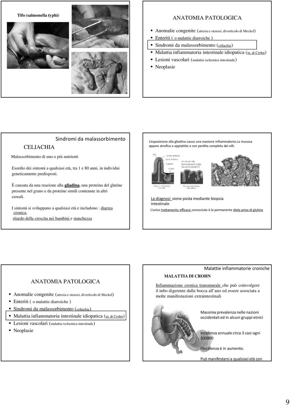 di Crohn) Lesioni vascolari (malattia ischemica intestinale) Neoplasie Sindromi da malassorbimento CELIACHIA L esposizione alla gliadina causa una reazione infiammatoria.