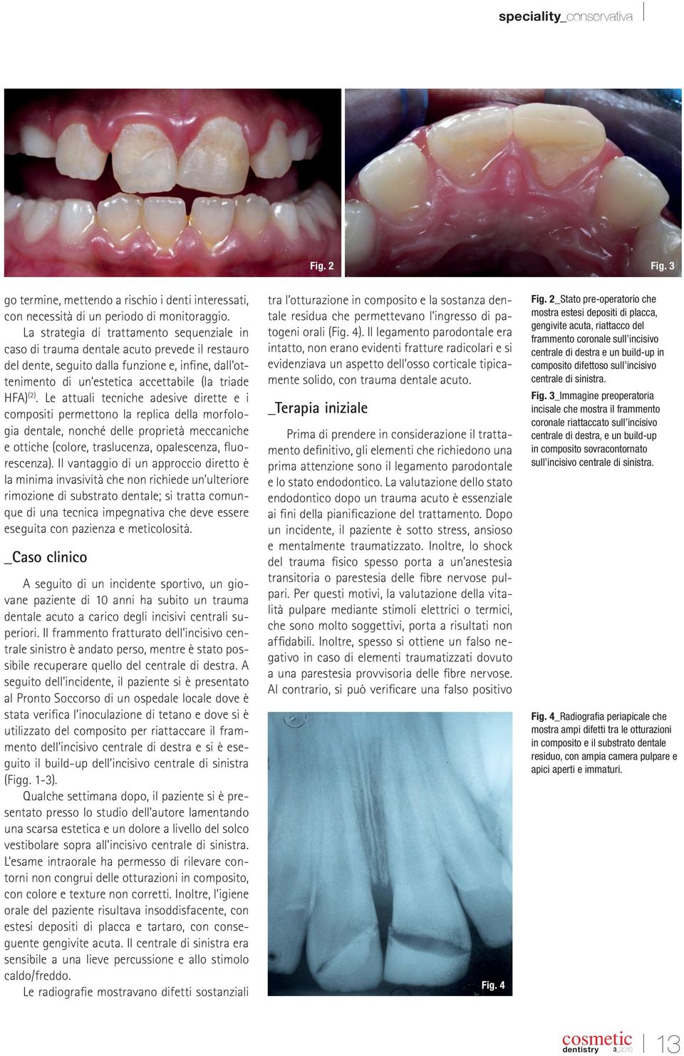 (2). Le attuali tecniche adesive dirette e i compositi permettono la replica della morfologia dentale, nonché delle proprietà meccaniche e ottiche (colore, traslucenza, opalescenza, fluorescenza).