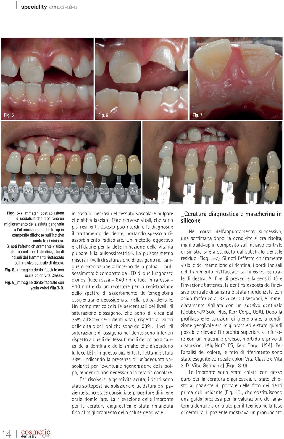 Si noti l effetto chiaramente visibile del mamellone di dentina, i bordi incisali del frammenti riattaccato sull incisivo centrale di destra. Fig.