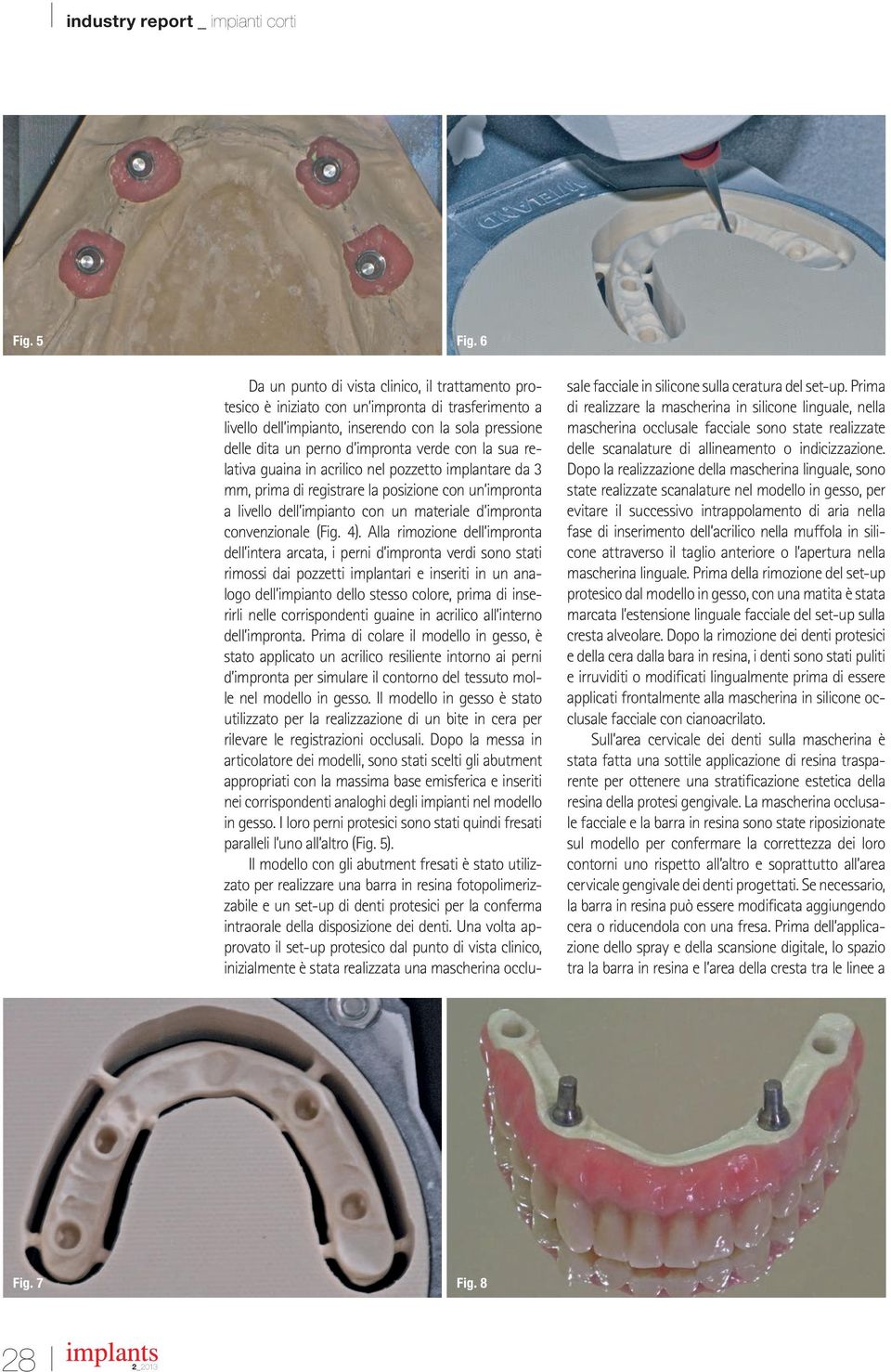 la sua relativa guaina in acrilico nel pozzetto implantare da 3 mm, prima di registrare la posizione con un impronta a livello dell impianto con un materiale d impronta convenzionale (Fig. 4).