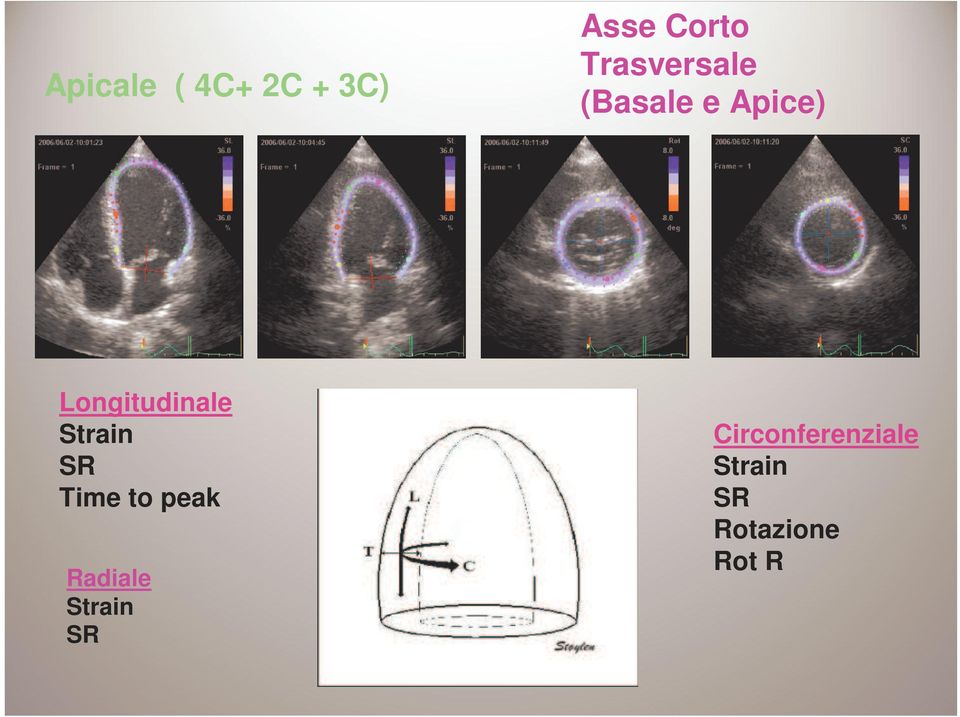 Longitudinale Strain SR Time to peak