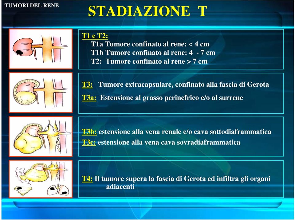 grasso perinefrico e/o al surrene T3b: estensione alla vena renale e/o cava sottodiaframmatica T3c:
