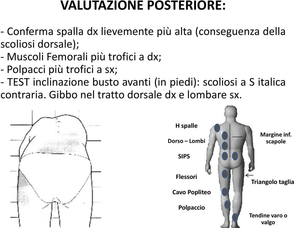 avanti (in piedi): scoliosi a S italica contraria. Gibbo nel tratto dorsale dx e lombare sx.