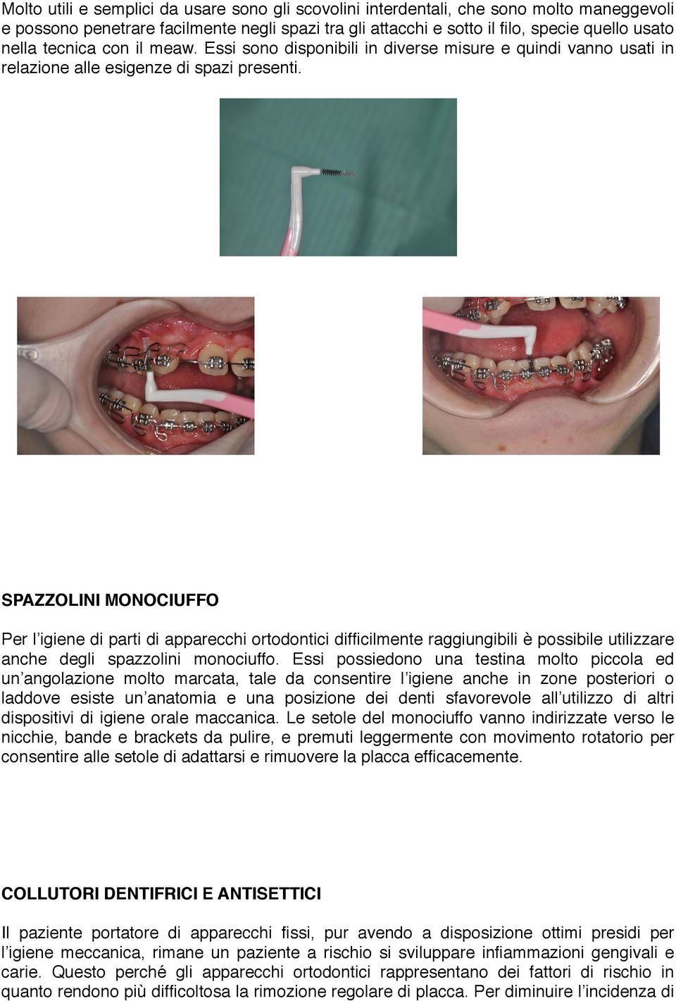 SPAZZOLINI MONOCIUFFO Per l igiene di parti di apparecchi ortodontici difficilmente raggiungibili è possibile utilizzare anche degli spazzolini monociuffo.