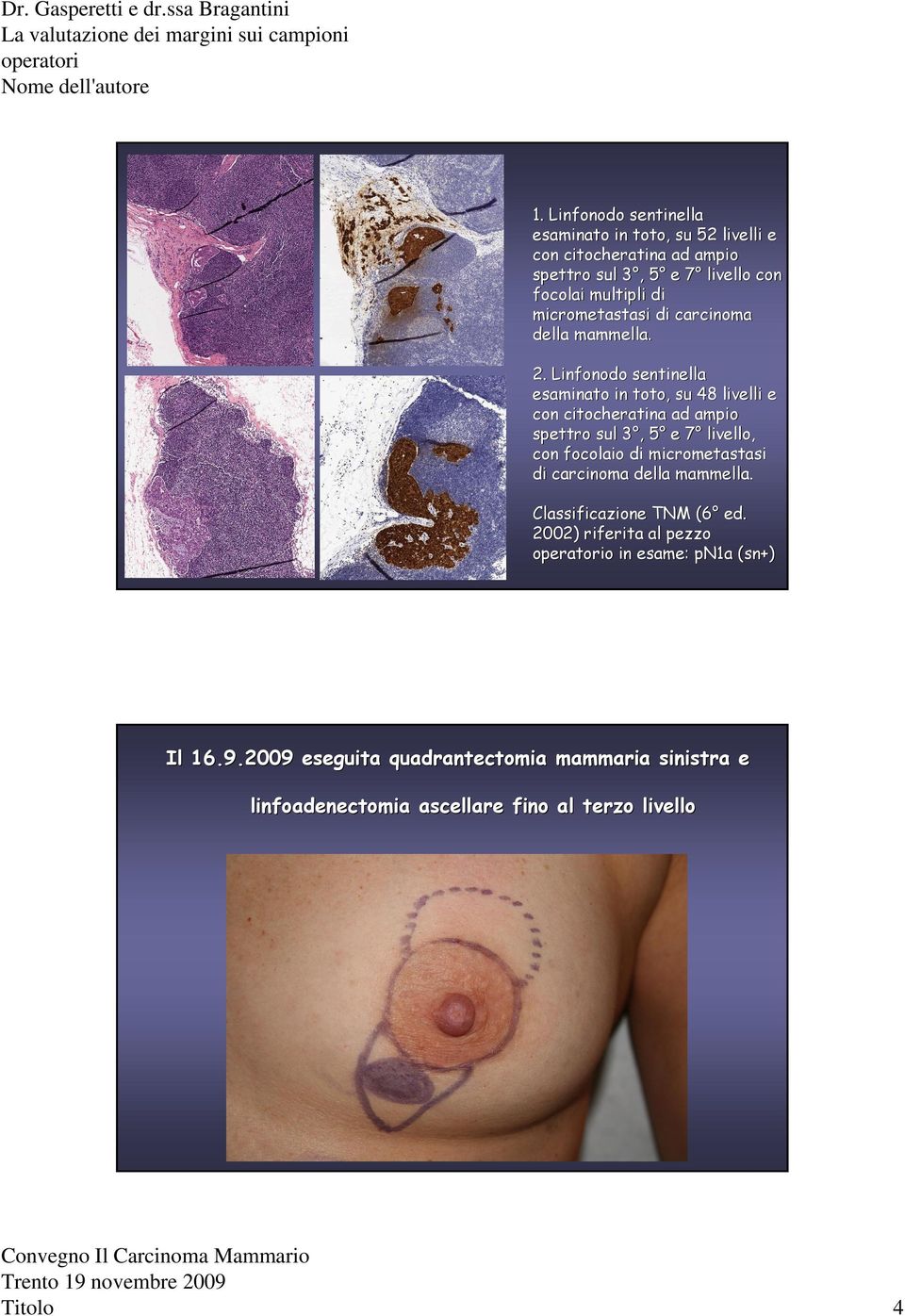 micrometastasi di carcinoma della mammella. 2.