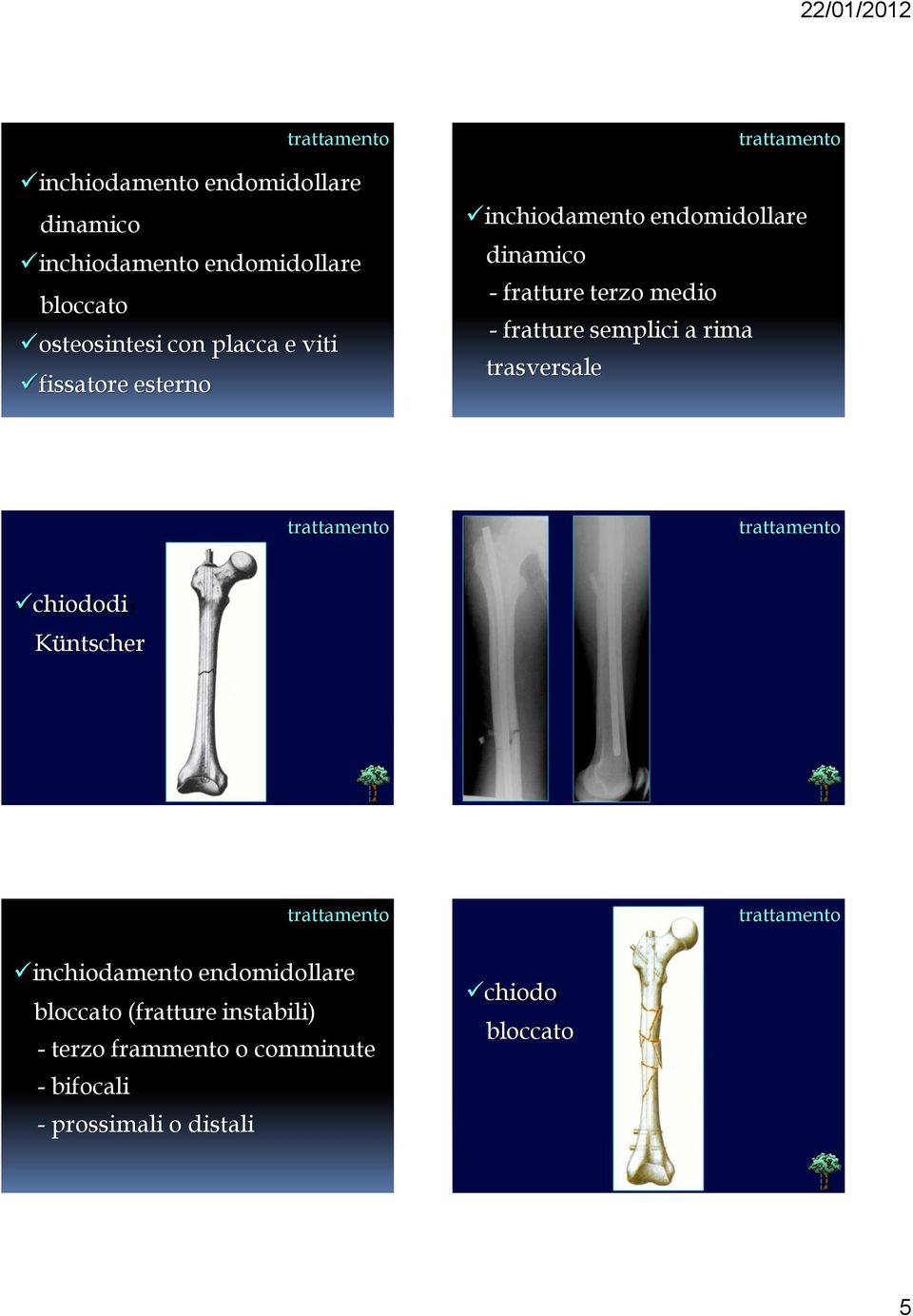 fratture semplici a rima trasversale chiododi Küntscher inchiodamento endomidollare bloccato