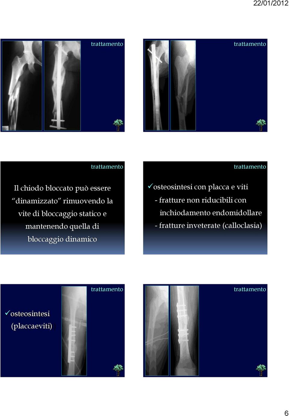 osteosintesi con placca e viti - fratture non riducibili con