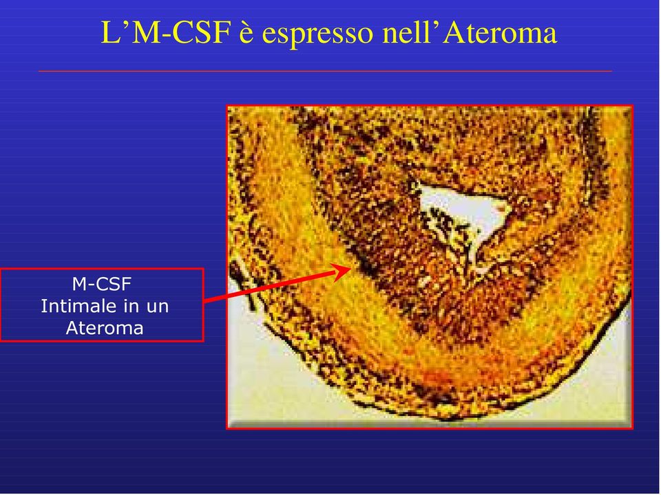 Ateroma M-CSF