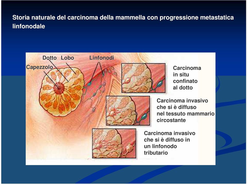 situ confinato al dotto Carcinoma invasivo che si è diffuso nel tessuto