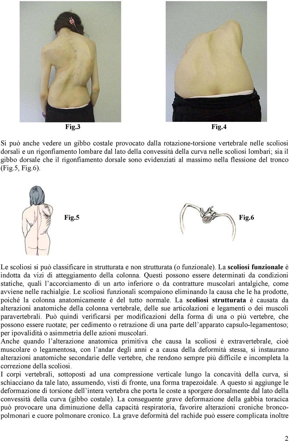 sia il gibbo dorsale che il rigonfiamento dorsale sono evidenziati al massimo nella flessione del tronco (Fig.5, Fig.6). Fig.5 Fig.