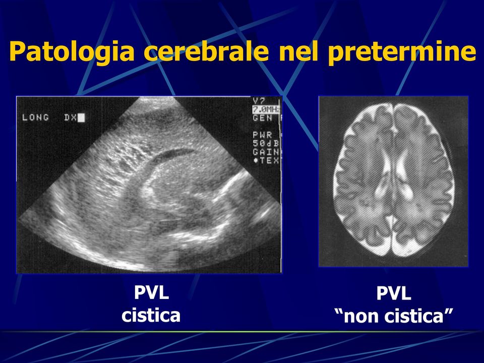 pretermine PVL