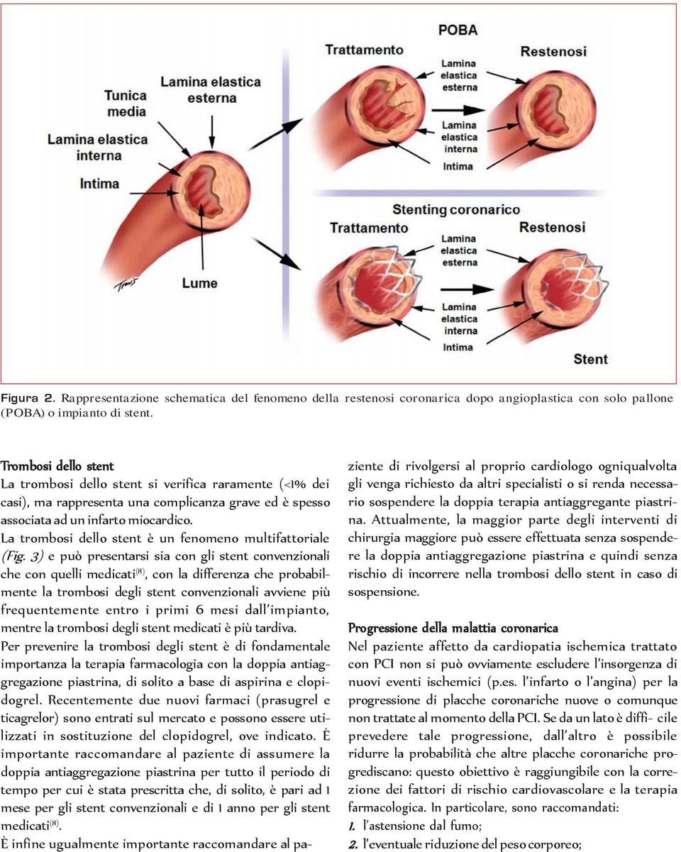 La trombosi dello stent è un fenomeno multifattoriale (Fig.