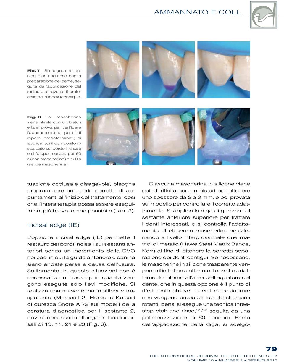 8 La mascherina viene rifinita con un bisturi e la si prova per verificare l adattamento ai punti di repere predeterminati; si applica poi il composito riscaldato sul bordo incisale e si