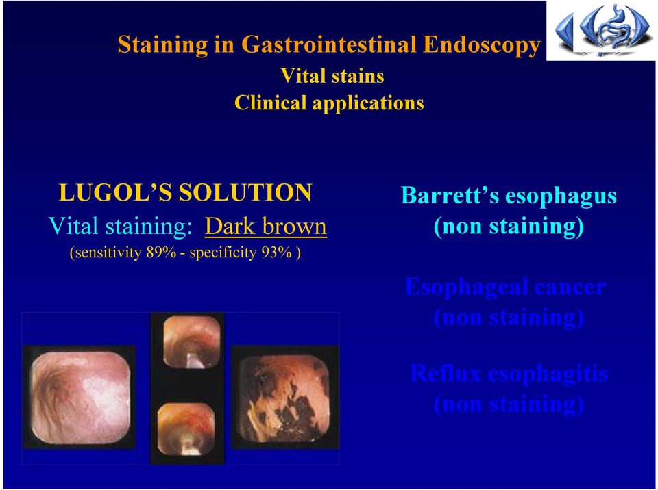 (sensitivity 89% - specificity 93% ) Barrett s esophagus (non