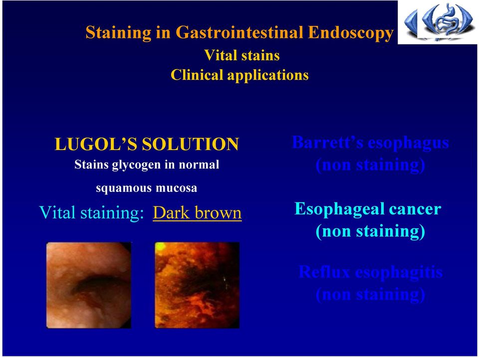 mucosa Vital staining: Dark brown Barrett s esophagus (non