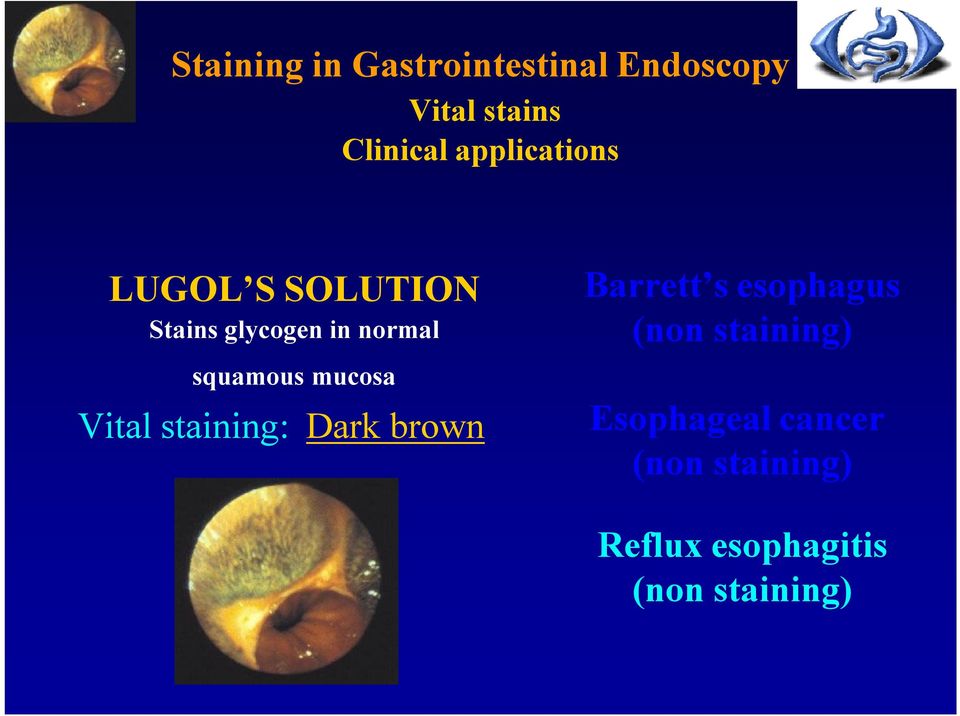 mucosa Vital staining: Dark brown Barrett s esophagus (non