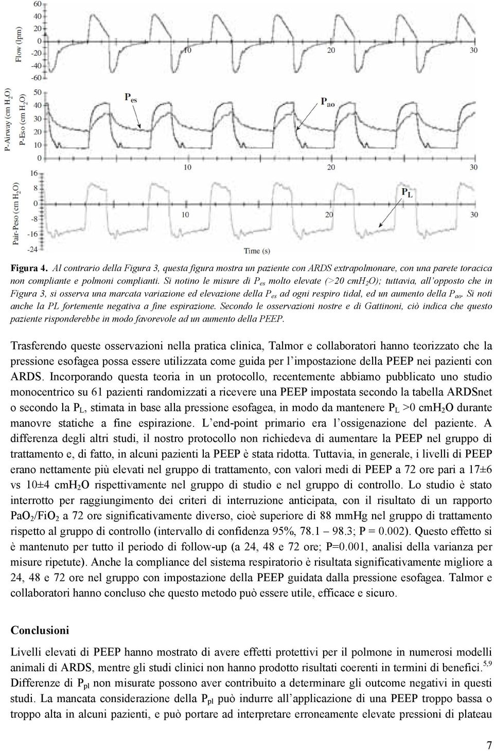 ao. Si noti anche la PL fortemente negativa a fine espirazione. Secondo le osservazioni nostre e di Gattinoni, ciò indica che questo paziente risponderebbe in modo favorevole ad un aumento della PEEP.