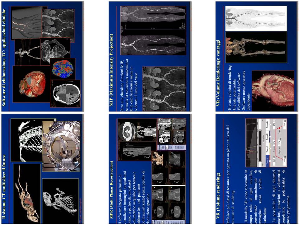 : nel paziente politraumatizzato) senza perdita di risoluzione spaziale MIP (Maximum Intensity Projection) Oltre alle classiche funzioni MIP, permette la sottrazione automatica delle calcificazioni e