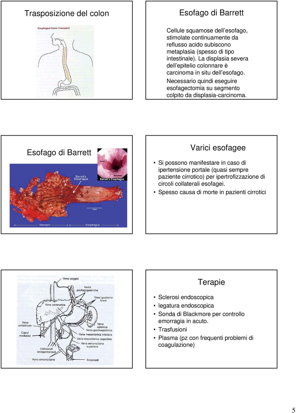 Esofago di Barrett Varici esofagee Si possono manifestare in caso di ipertensione portale (quasi sempre paziente cirrotico) per ipertrofizzazione di circoli collaterali esofagei.