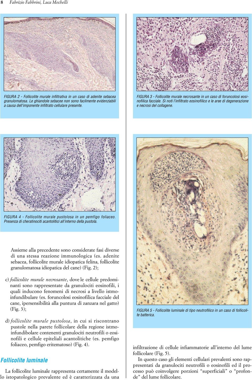 Si noti l infiltrato eosinofilico e le aree di degenerazione e necrosi del collagene. FIGURA 4 - Follicolite murale pustolosa in un pemfigo foliaceo.